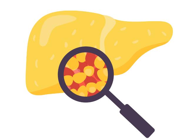 脂肪肝是如何一步一步发展成肝癌的？